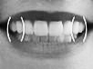 Perfect Smile smile width
